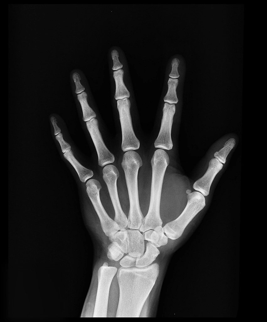 엑스레이 (X-Ray)